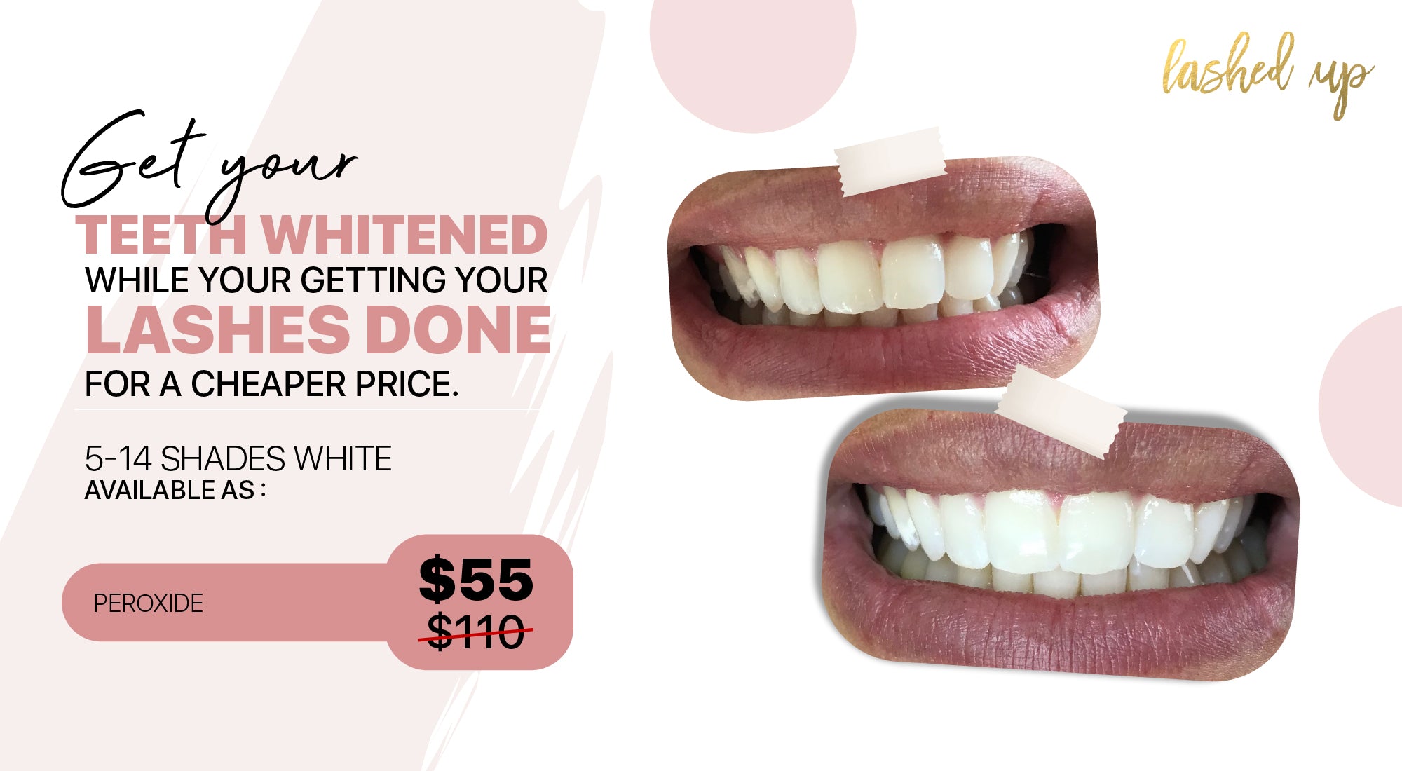 The facts about teeth whitening